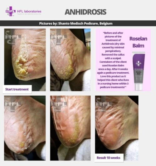 HFL Laboratories Roselan salv eriti kuivale nahale ja paksenditele