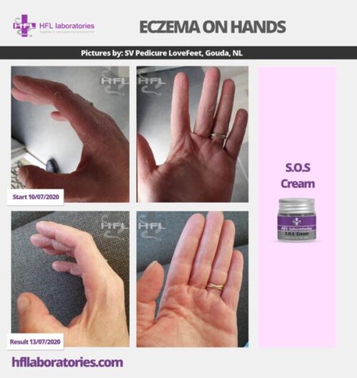 S.O.S. крем для раздраженной кожи