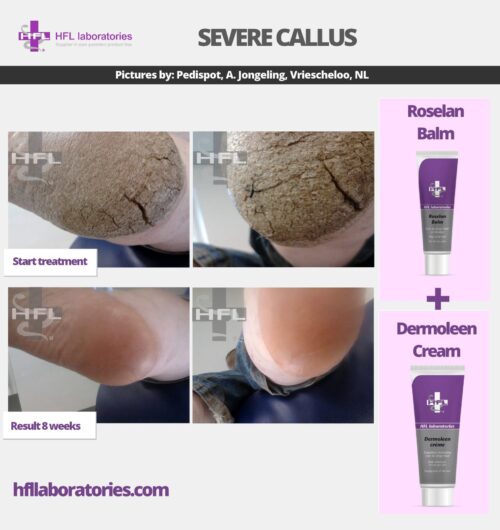 HFL Laboratories Roselan salv eriti kuivale nahale ja paksenditele