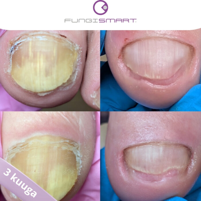 3 kuud FungiSmarti kasutamist