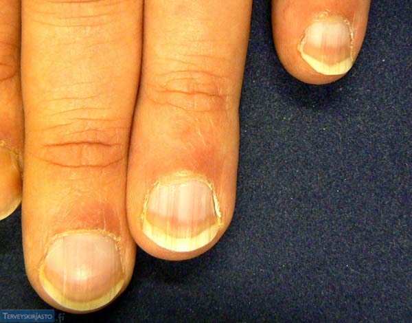 Psoriaas küüntel – sümptomid ja igapäevane hooldus