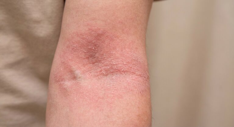 Ekseem ja dermatiit: sümptomid ja tõhus hooldus