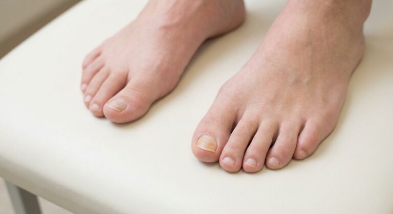 Küünte värvimuutused ja nende põhjused: mida su varbad sulle räägivad?