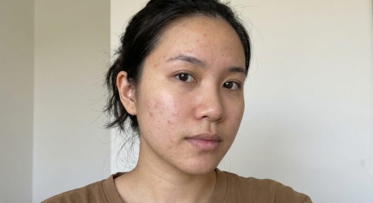 Niatsiinamiid nahahoolduses: kuidas valida õige kontsentratsioon ja tooted?