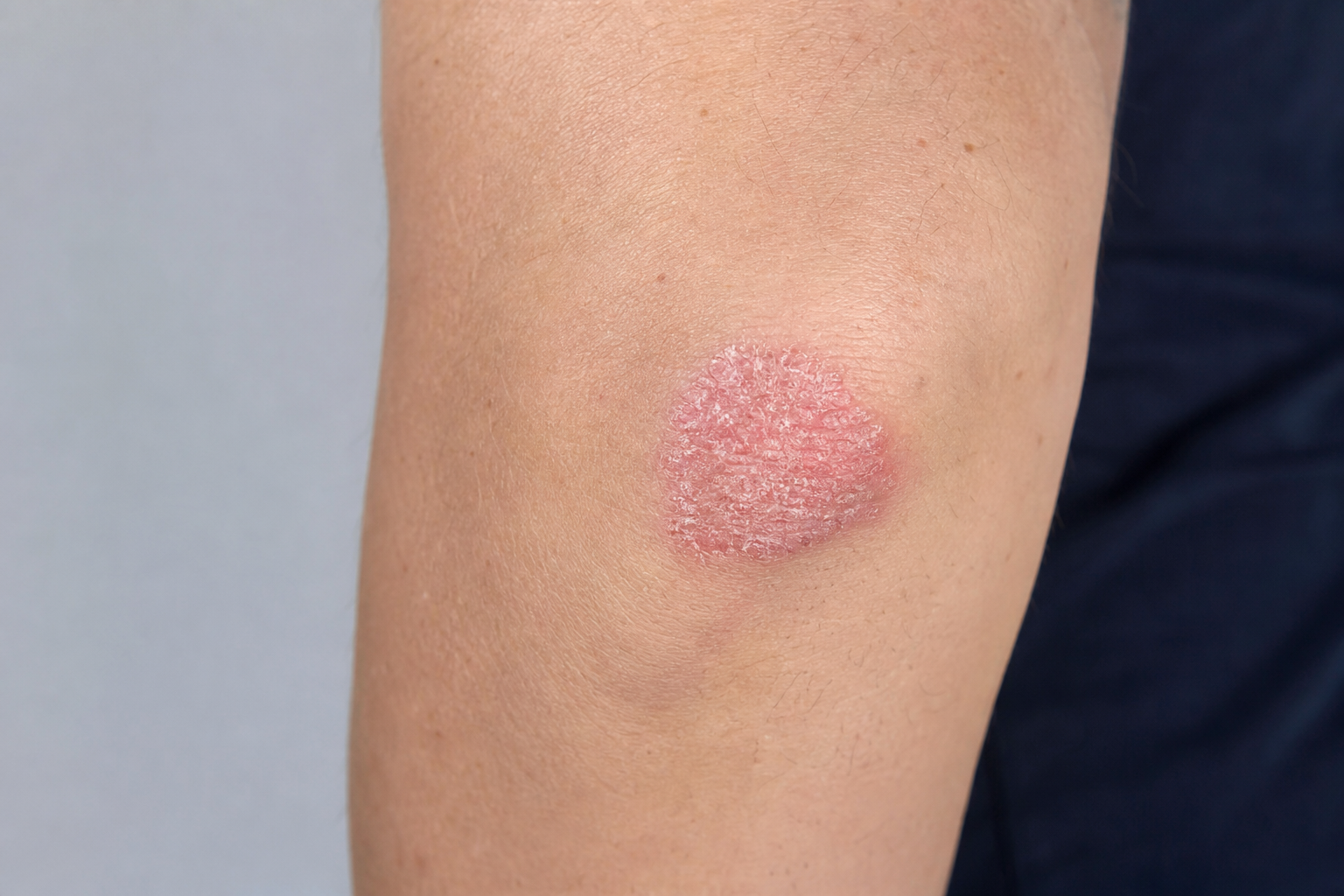 Psoriaasi sümptomeid ja ketendust saab õige nahahooldusega leevendada. Loe lähemalt rutiinide, uurea, salitsüülhappe ja naha kaitsebarjääri tugevdamise kohta.
T